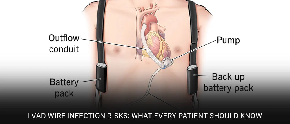 LVAD Wire Infection Risks: What Every Patient Should Know