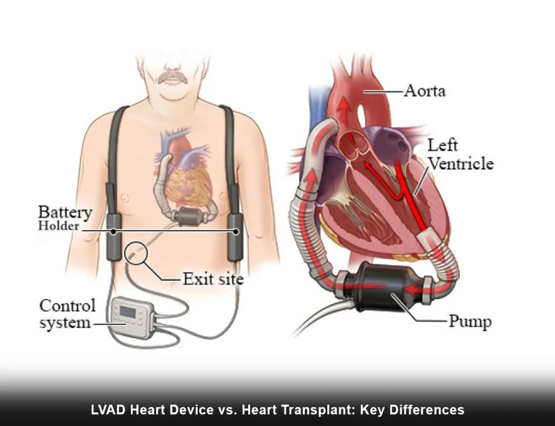 lvad-heart-device-vs-heart-transplant-key-differences