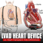 lvad-heart-device-vs-heart-transplant-key-differences