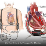 LVAD Heart Device vs. Heart Transplant: Key Differences