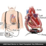 lvad-heart-device-vs-heart-transplant-key-differences