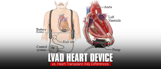 lvad-heart-device-vs-heart-transplant-key-differences