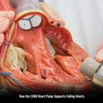 How the LVAD Heart Pump Supports Failing Hearts: